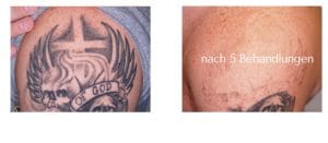 tattooentfernung-tattoo-lasern-rostock-aesthetikzentrum-rostock