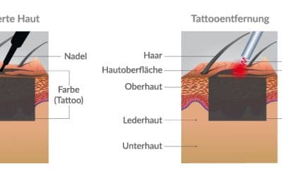 So funktioniert Laser Tattooentfernung