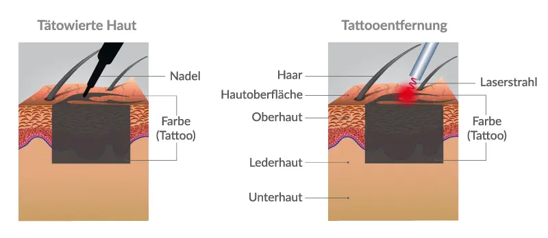So funktioniert Laser Tattooentfernung