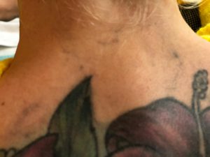 Tattooentfernung Laser Rostock | nach 1 Behandlung (lange Ruhephase)