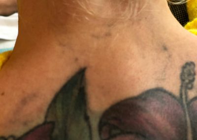 Tattooentfernung Laser Rostock | nach 1 Behandlung (lange Ruhephase)