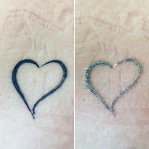 Tattooentfernung Rostock | vor der Behandlung