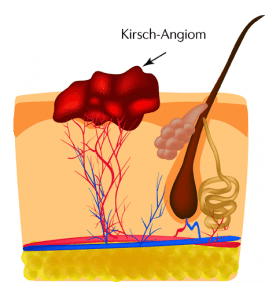 hemangioma removal entfernung kirsch angiom laser rostock